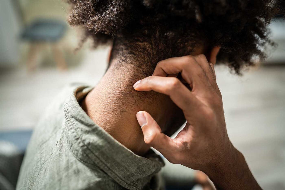 Should I Cut My Hair If I Have Psoriasis?