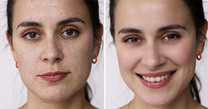 Why Is My Skin Dry When Moisturizing? Science-Based Answer - HarlanMD