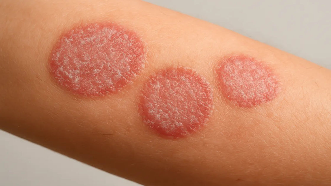 Nummular Eczema: Why Those Coin-Shaped Rashes Won't Heal