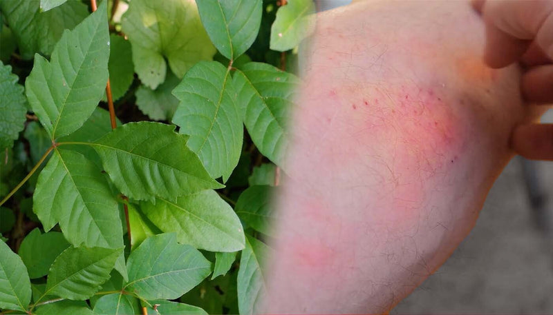 Stop Rhus Dermatitis Fast: Evidence-Based Treatment - HarlanMD