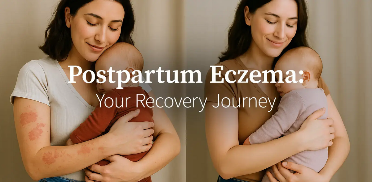 Postpartum Eczema: Why Your Skin Flares After Delivery
