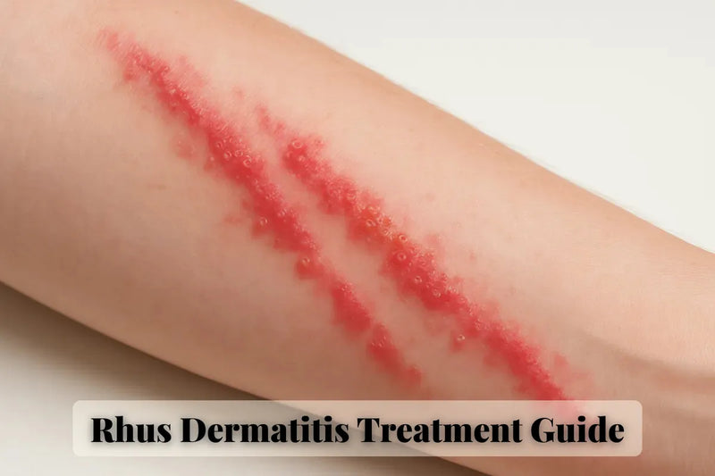 Stop Rhus Dermatitis Fast: Evidence-Based Treatment