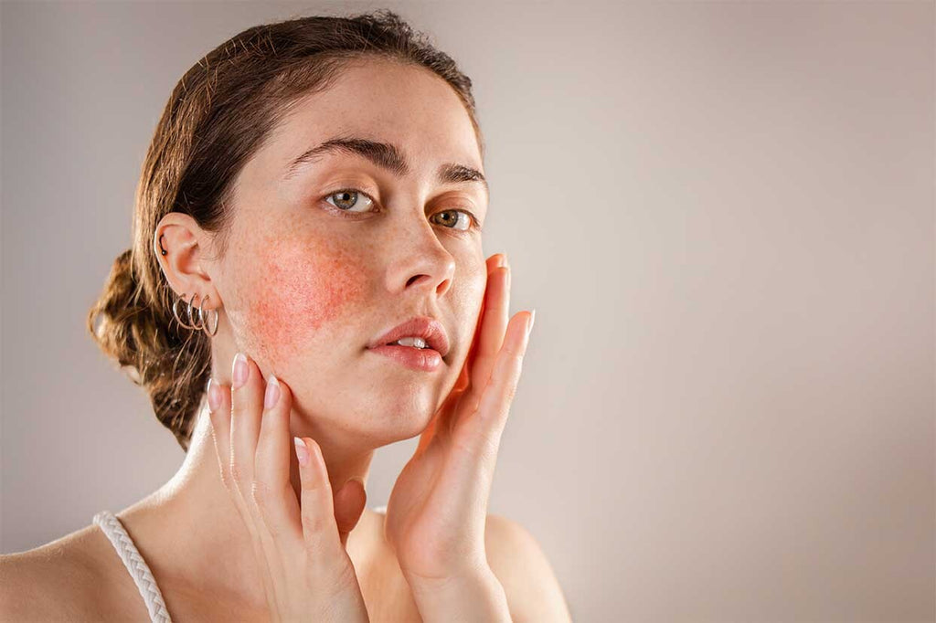 Can I Use An Eczema Product for Rosacea?