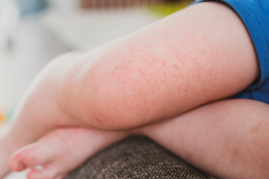 Got Eczema? Top Skincare Ingredients You Should Avoid