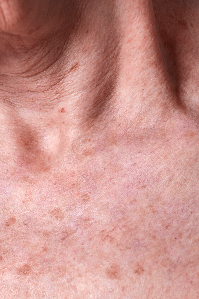 What Is Actinic Keratosis? Here’s What You Need to Know