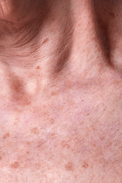 What Is Actinic Keratosis? Here’s What You Need to Know