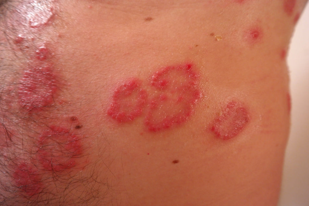 4 Types of Skin Rashes Commonly Seen in Adults - HarlanMD