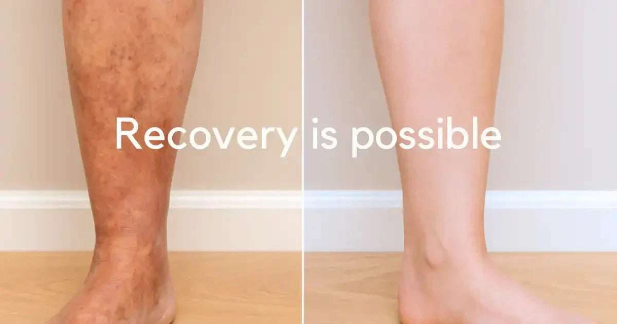 Stasis Dermatitis Treatment That Works When Others Fail