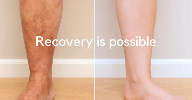 Stasis Dermatitis Treatment That Works When Others Fail - HarlanMD